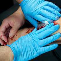 Healthcare worker wearing latex gloves dressing a bloody arm wound